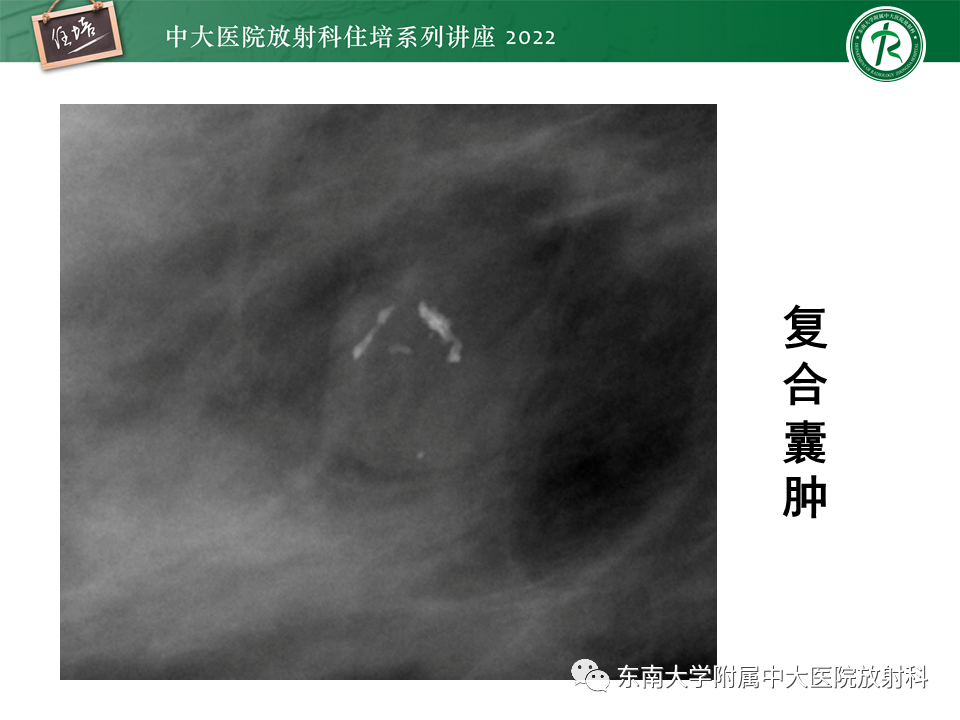 影像PPT - 【PPT】乳腺X线影像报告和数据系统（第五版）BI-RADS-22