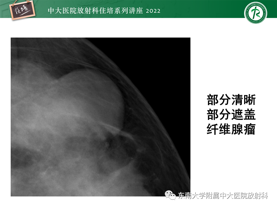 影像PPT - 【PPT】乳腺X线影像报告和数据系统（第五版）BI-RADS-21