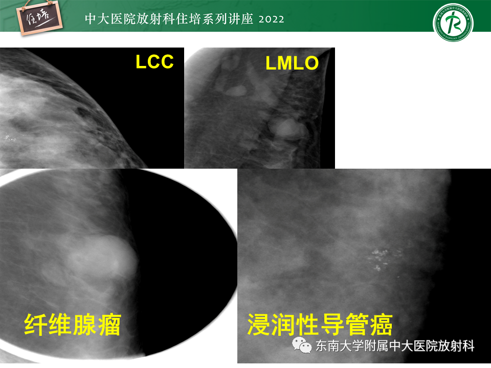 影像PPT - 【PPT】乳腺X线影像报告和数据系统（第五版）BI-RADS-26