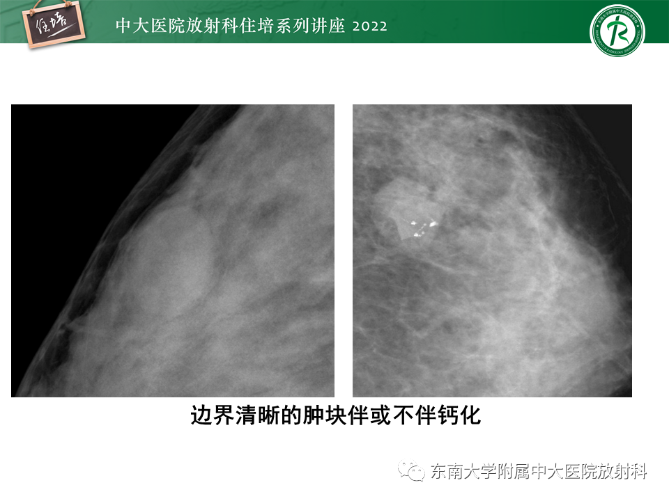 影像PPT - 【PPT】乳腺X线影像报告和数据系统（第五版）BI-RADS-11