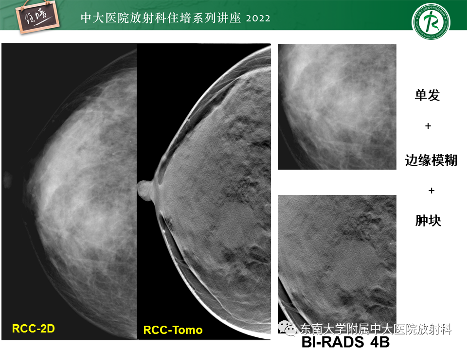 影像PPT - 【PPT】乳腺X线影像报告和数据系统（第五版）BI-RADS-29