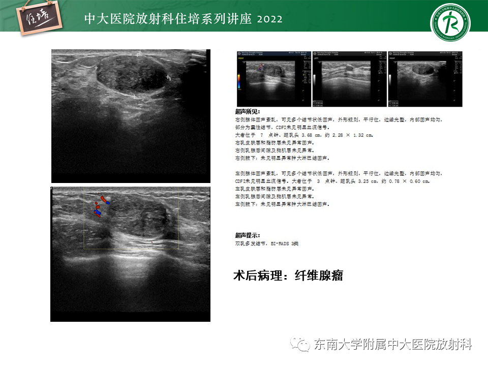 影像PPT - 【PPT】乳腺X线影像报告和数据系统（第五版）BI-RADS-13