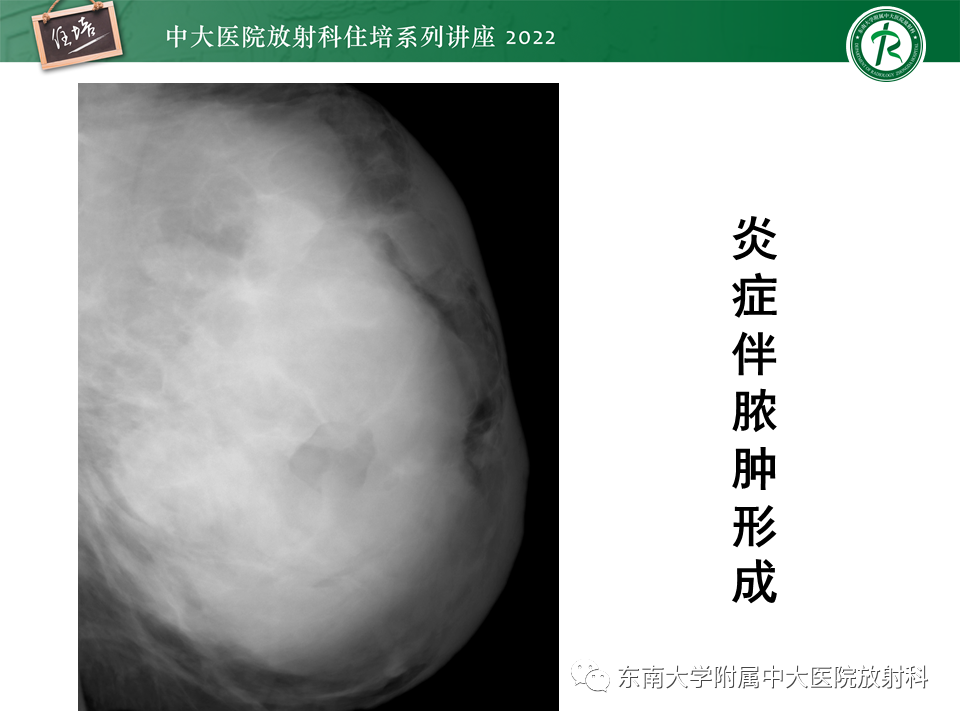 影像PPT - 【PPT】乳腺X线影像报告和数据系统（第五版）BI-RADS-23
