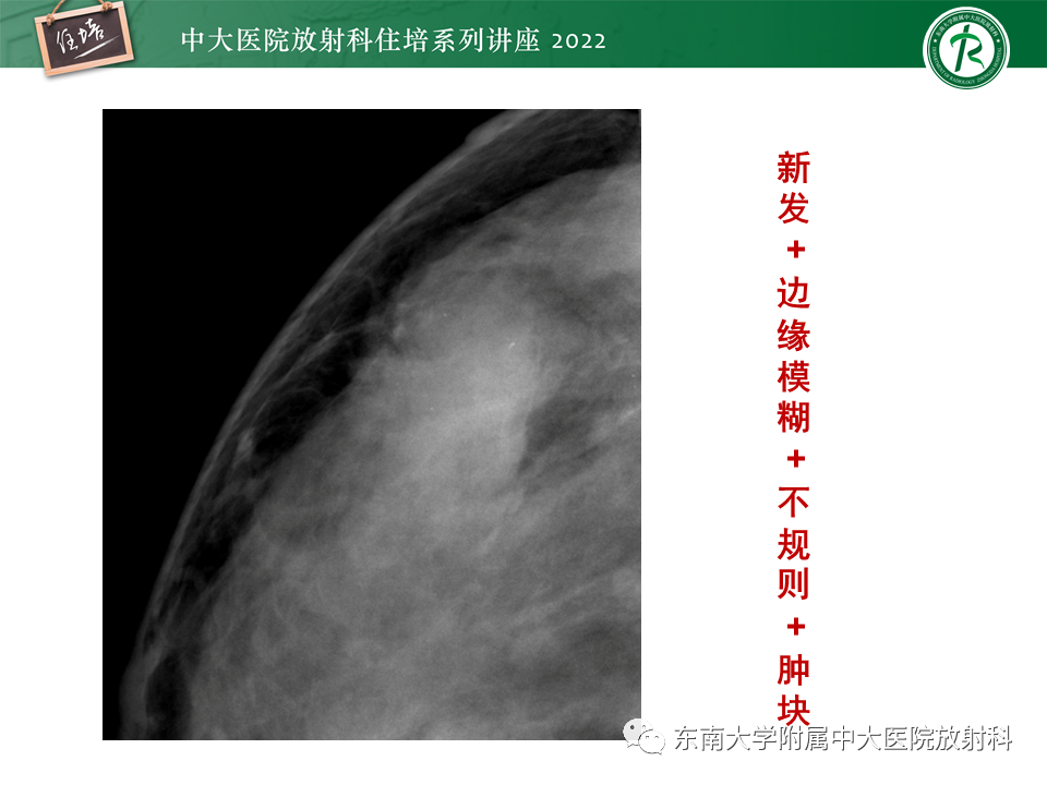 影像PPT - 【PPT】乳腺X线影像报告和数据系统（第五版）BI-RADS-31