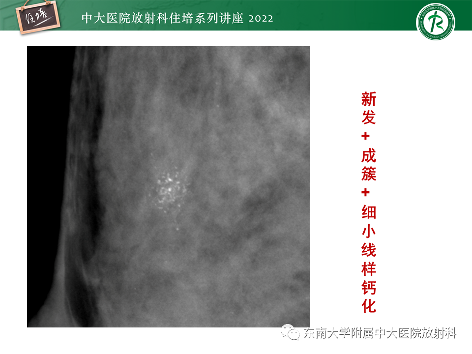 影像PPT - 【PPT】乳腺X线影像报告和数据系统（第五版）BI-RADS-32