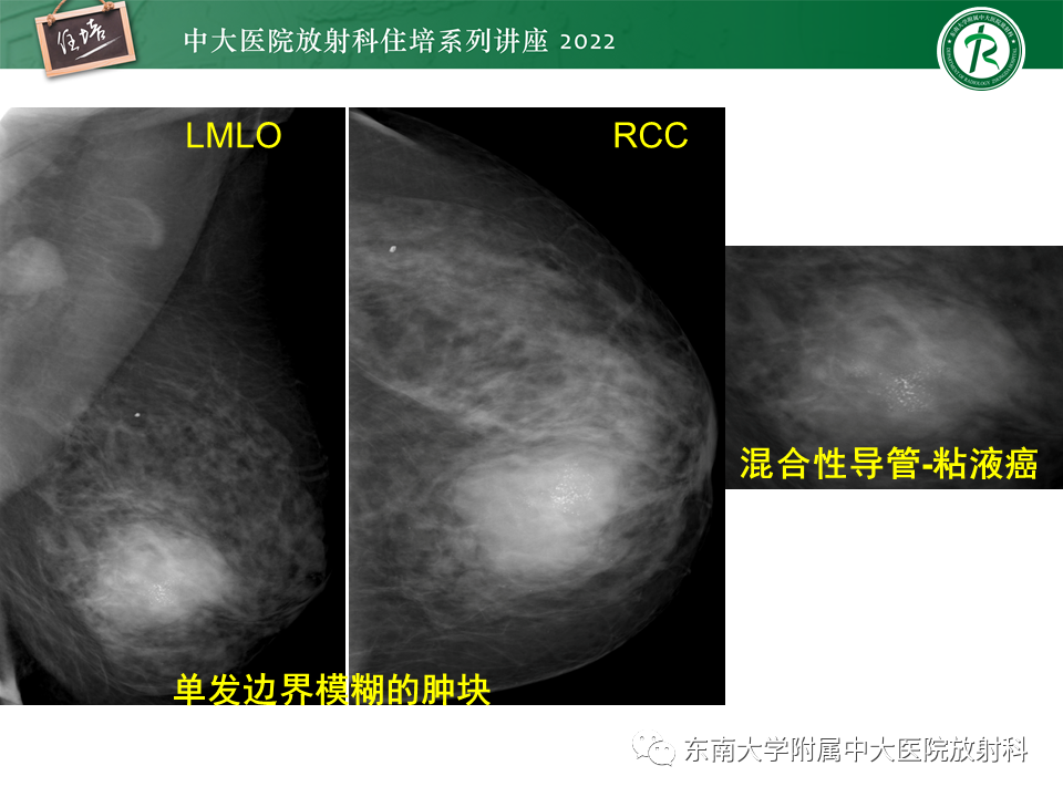 影像PPT - 【PPT】乳腺X线影像报告和数据系统（第五版）BI-RADS-33