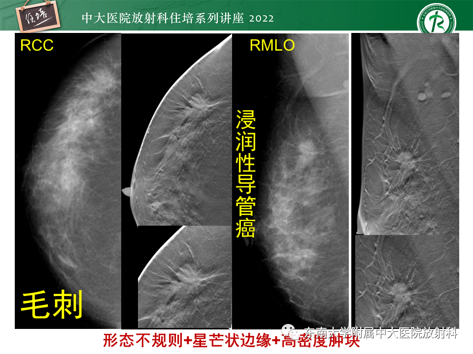 影像PPT - 【PPT】乳腺X线影像报告和数据系统（第五版）BI-RADS-35