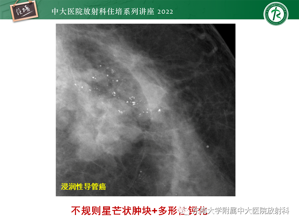 影像PPT - 【PPT】乳腺X线影像报告和数据系统（第五版）BI-RADS-37
