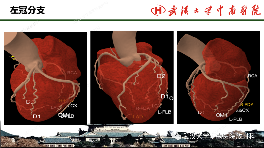 影像PPT - 【PPT】冠脉解剖与先天变异-9