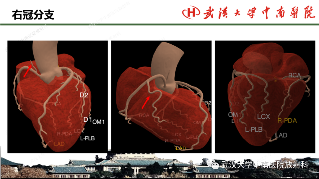 影像PPT - 【PPT】冠脉解剖与先天变异-7
