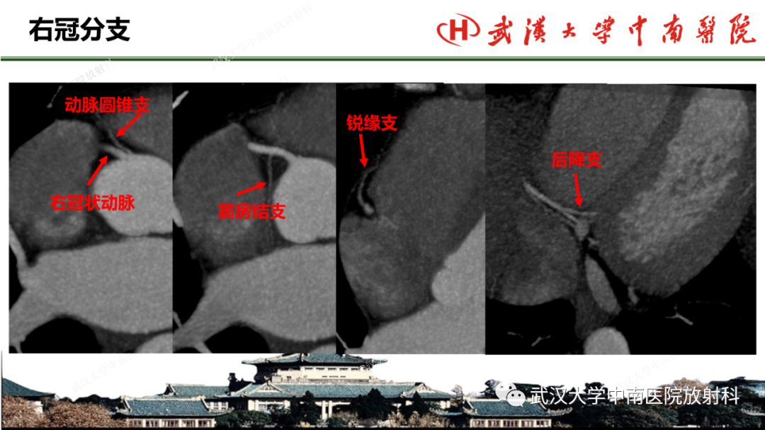 影像PPT - 【PPT】冠脉解剖与先天变异-6