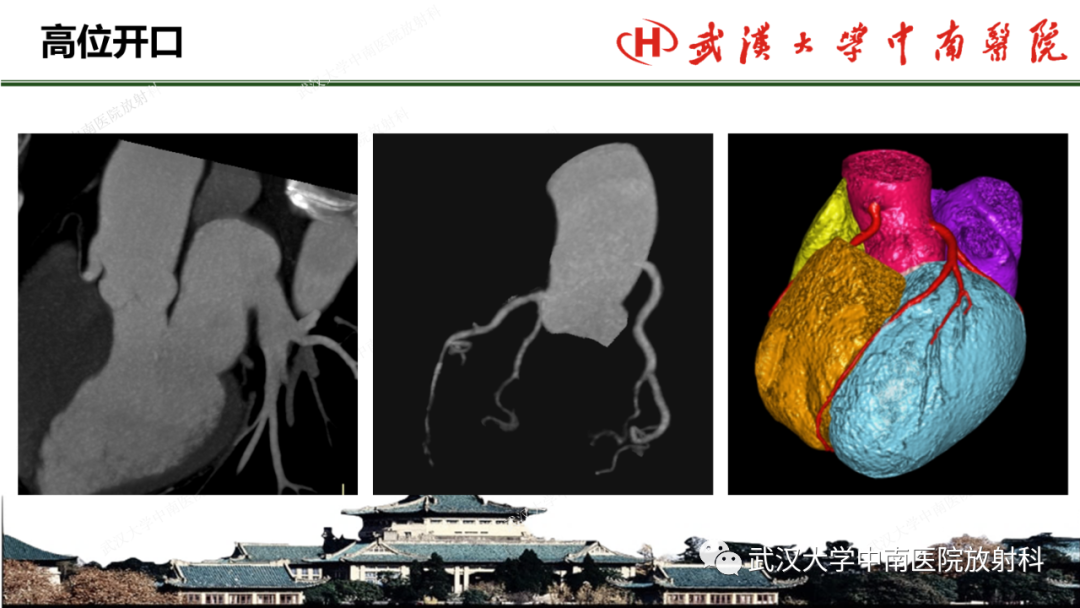 影像PPT - 【PPT】冠脉解剖与先天变异-18
