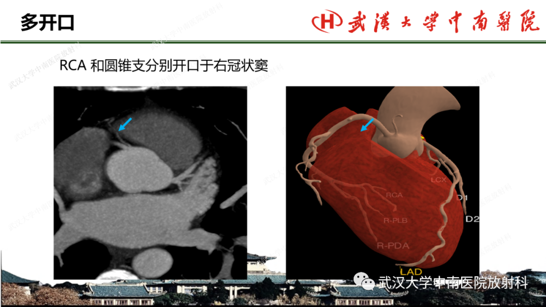 影像PPT - 【PPT】冠脉解剖与先天变异-19