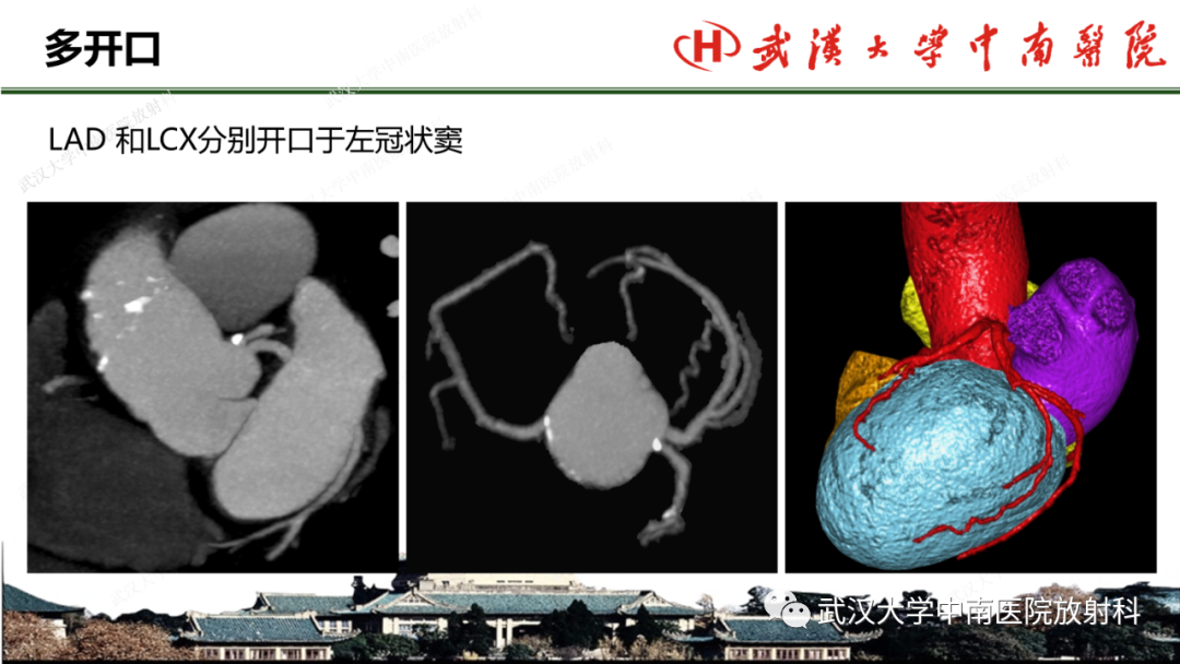 影像PPT - 【PPT】冠脉解剖与先天变异-20