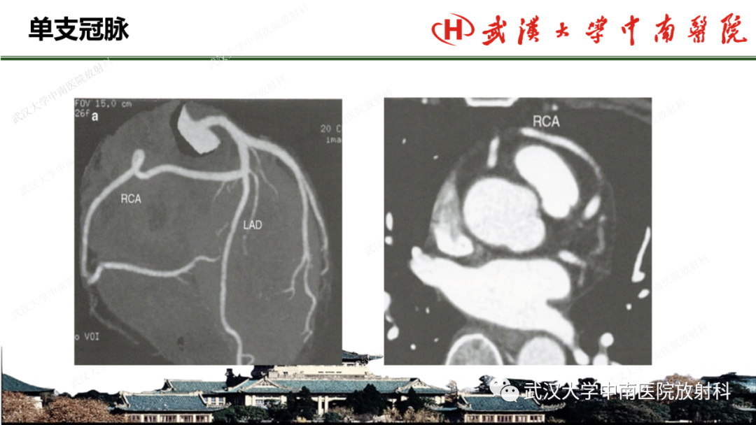 影像PPT - 【PPT】冠脉解剖与先天变异-22