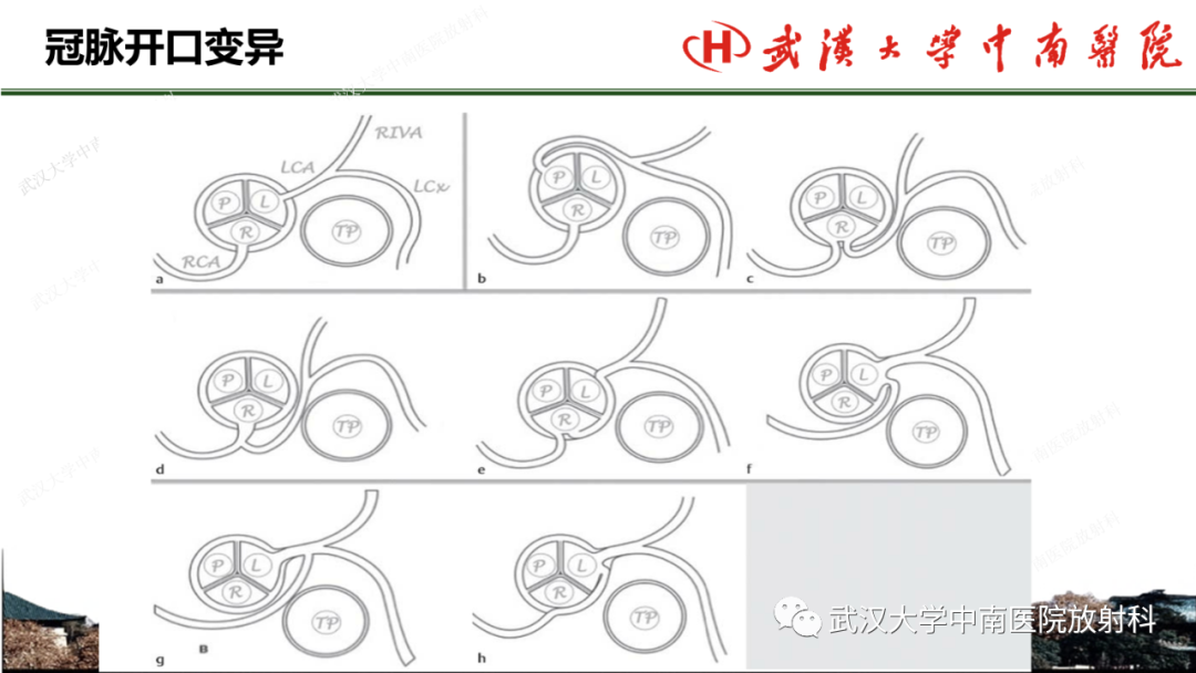 影像PPT - 【PPT】冠脉解剖与先天变异-23