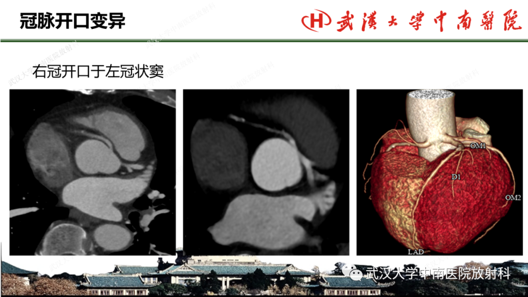 影像PPT - 【PPT】冠脉解剖与先天变异-24