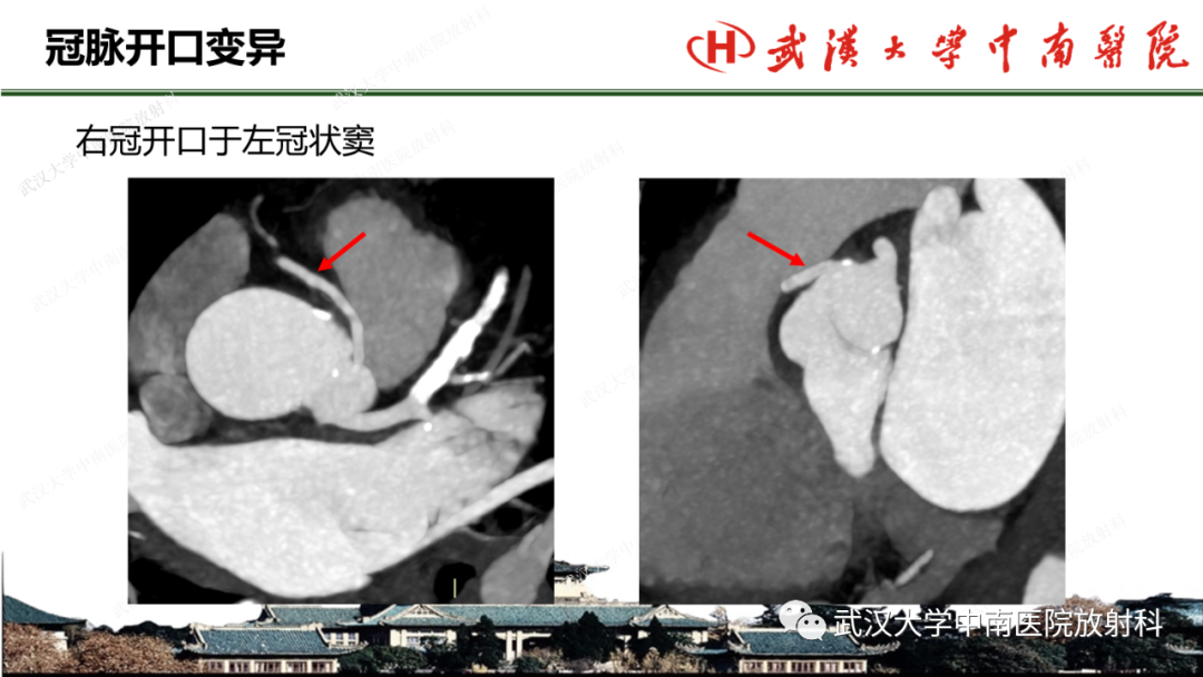 影像PPT - 【PPT】冠脉解剖与先天变异-25
