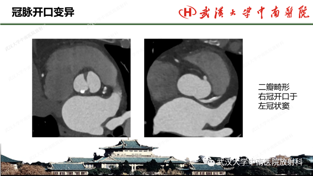 影像PPT - 【PPT】冠脉解剖与先天变异-26