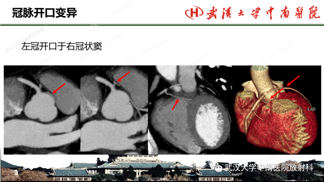 影像PPT - 【PPT】冠脉解剖与先天变异-27