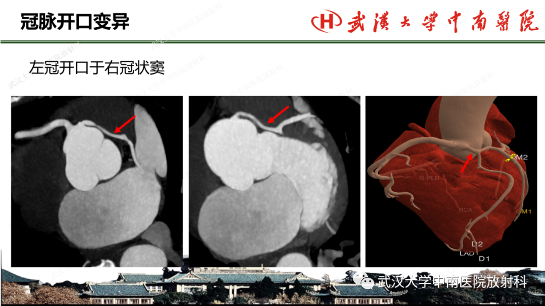 影像PPT - 【PPT】冠脉解剖与先天变异-28