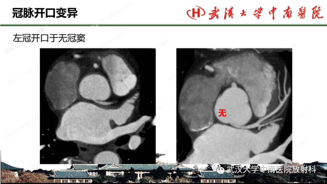 影像PPT - 【PPT】冠脉解剖与先天变异-29