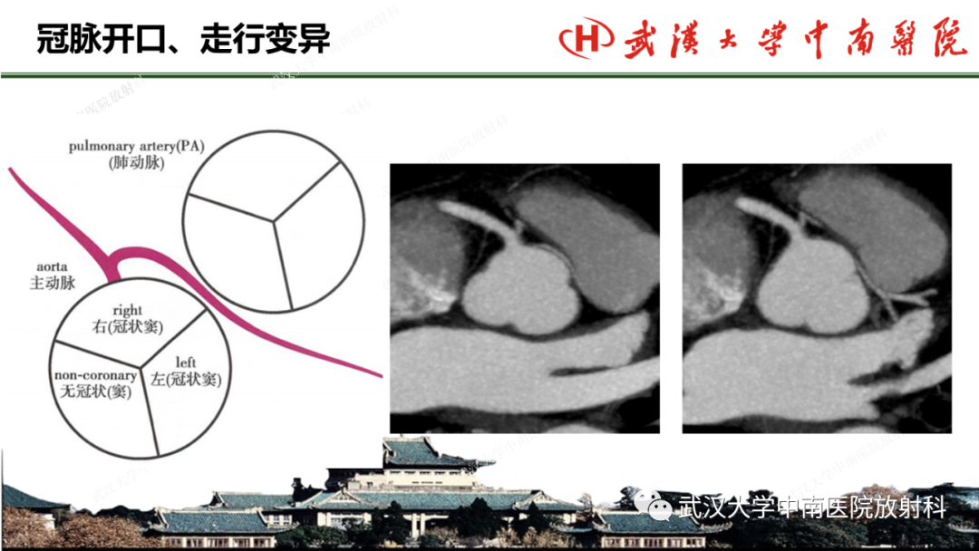影像PPT - 【PPT】冠脉解剖与先天变异-30