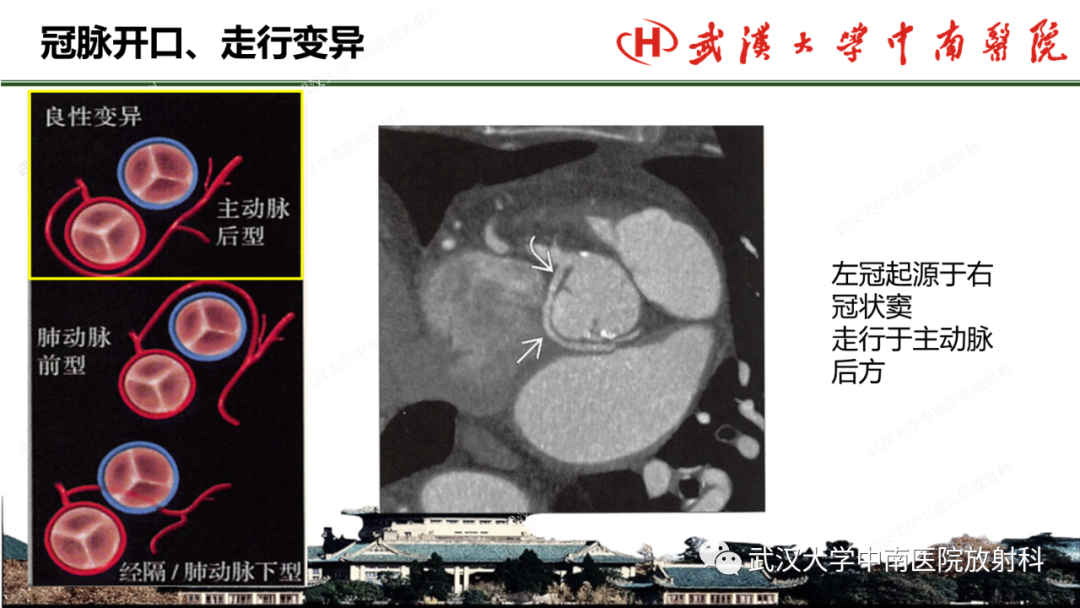 影像PPT - 【PPT】冠脉解剖与先天变异-32