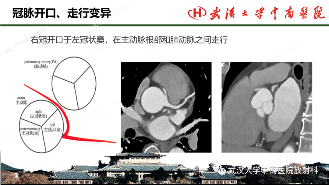 影像PPT - 【PPT】冠脉解剖与先天变异-31