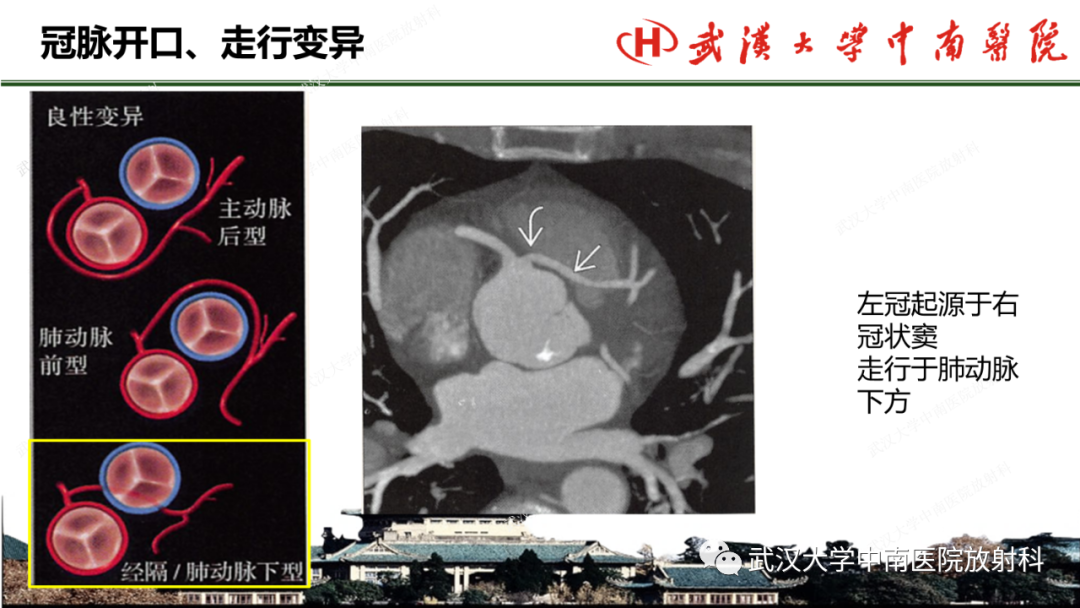 影像PPT - 【PPT】冠脉解剖与先天变异-33
