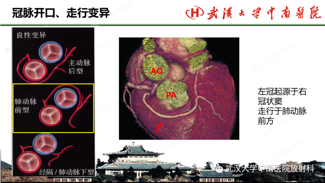 影像PPT - 【PPT】冠脉解剖与先天变异-34