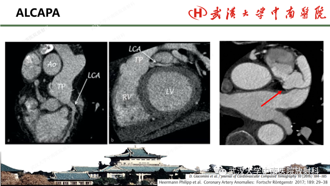 影像PPT - 【PPT】冠脉解剖与先天变异-37