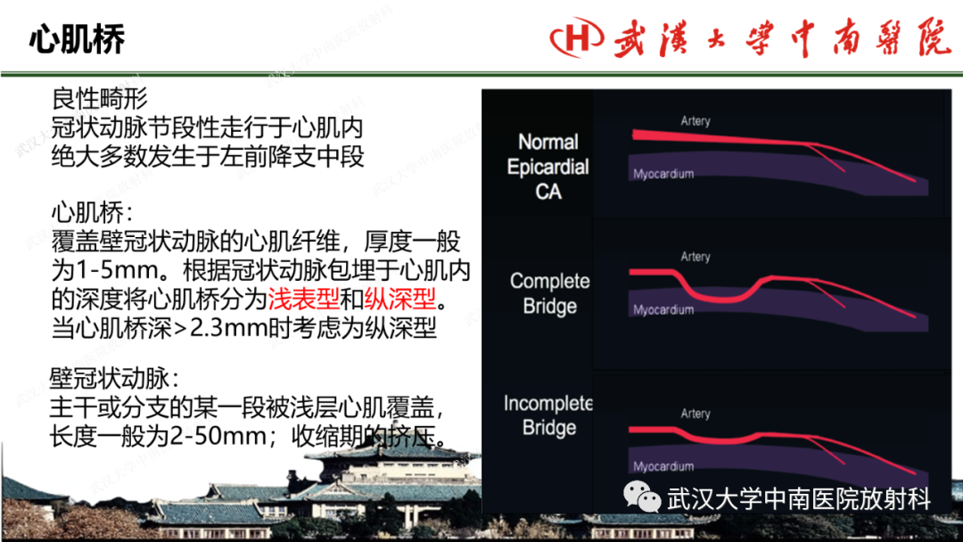 影像PPT - 【PPT】冠脉解剖与先天变异-38