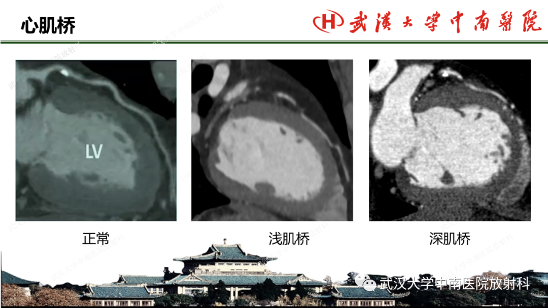 影像PPT - 【PPT】冠脉解剖与先天变异-39