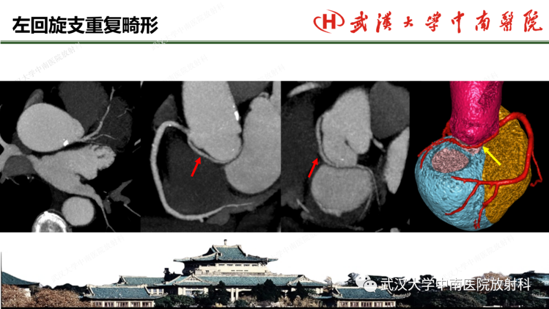 影像PPT - 【PPT】冠脉解剖与先天变异-42
