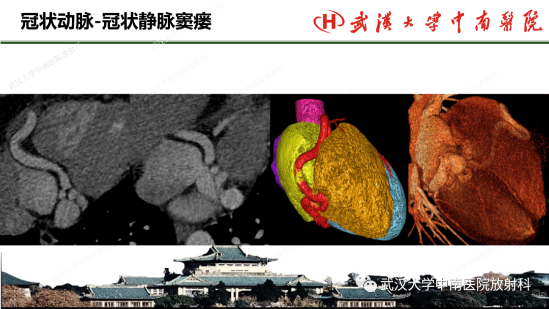 影像PPT - 【PPT】冠脉解剖与先天变异-46