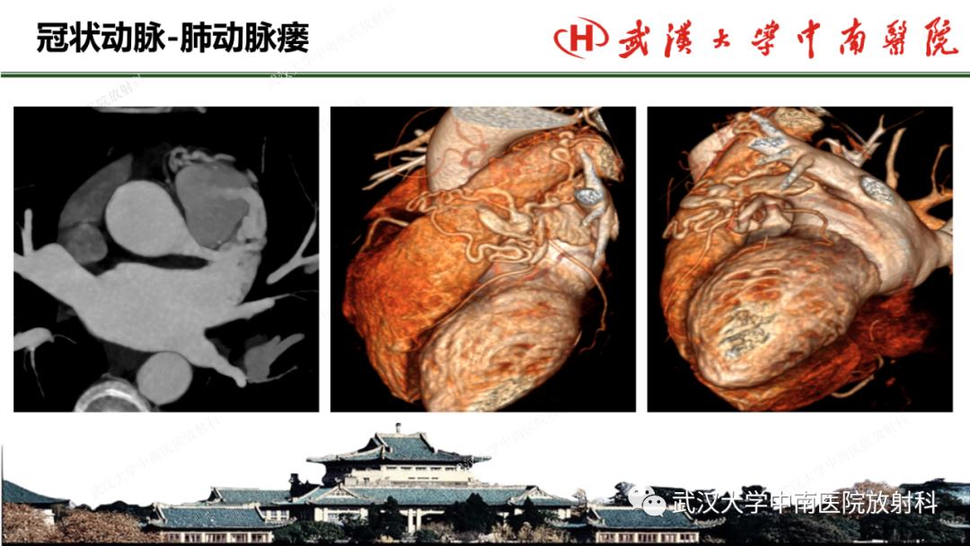 影像PPT - 【PPT】冠脉解剖与先天变异-47