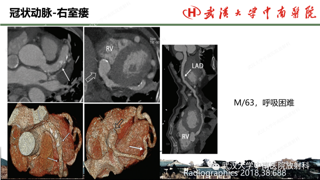 影像PPT - 【PPT】冠脉解剖与先天变异-49