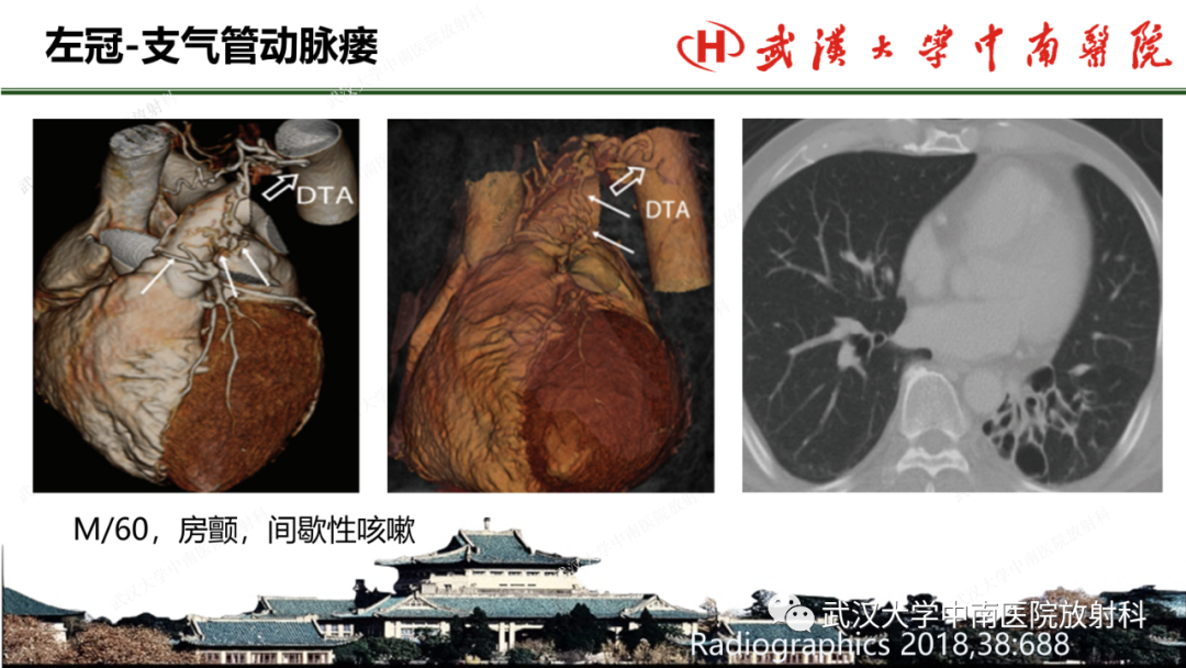 影像PPT - 【PPT】冠脉解剖与先天变异-50