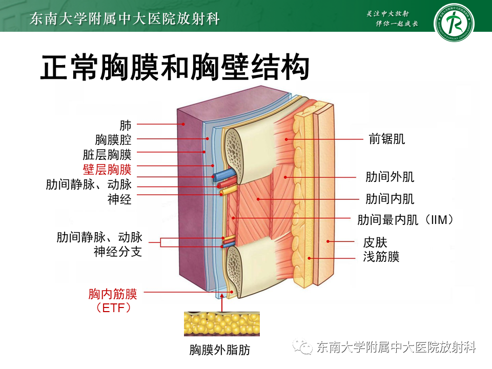 影像PPT - 【PPT】胸膜孤立性纤维瘤-4 影像PPT - 【PPT】胸膜孤立性纤维瘤-4