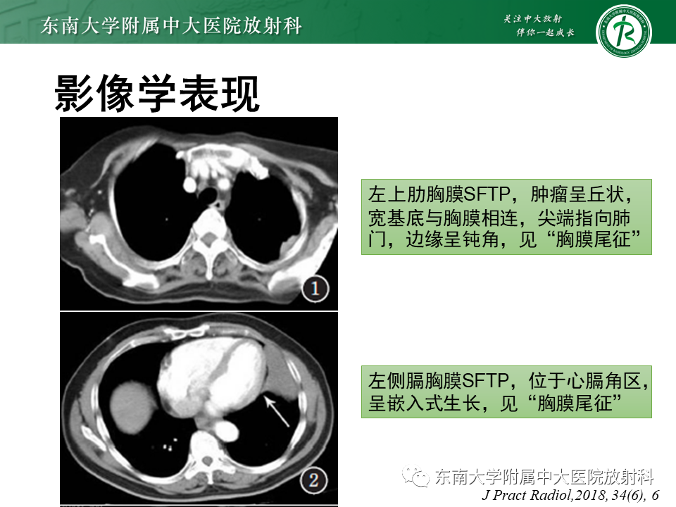影像PPT - 【PPT】胸膜孤立性纤维瘤-14 影像PPT - 【PPT】胸膜孤立性纤维瘤-14