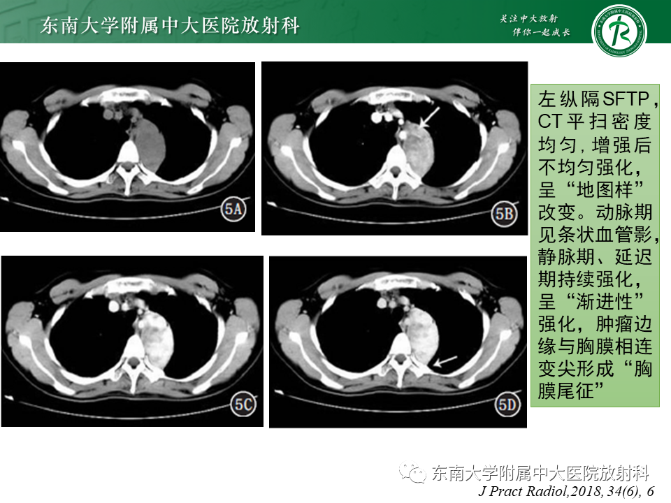 影像PPT - 【PPT】胸膜孤立性纤维瘤-16 影像PPT - 【PPT】胸膜孤立性纤维瘤-16