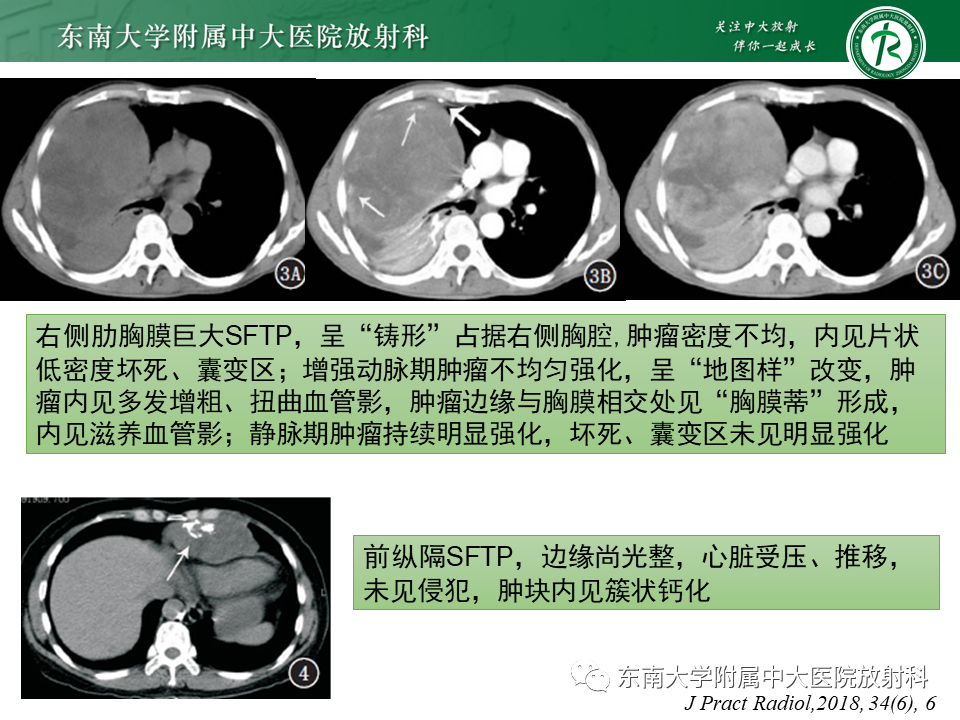 影像PPT - 【PPT】胸膜孤立性纤维瘤-15 影像PPT - 【PPT】胸膜孤立性纤维瘤-15