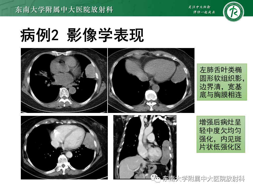 影像PPT - 【PPT】胸膜孤立性纤维瘤-18 影像PPT - 【PPT】胸膜孤立性纤维瘤-18