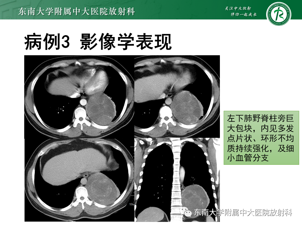 影像PPT - 【PPT】胸膜孤立性纤维瘤-23 影像PPT - 【PPT】胸膜孤立性纤维瘤-23