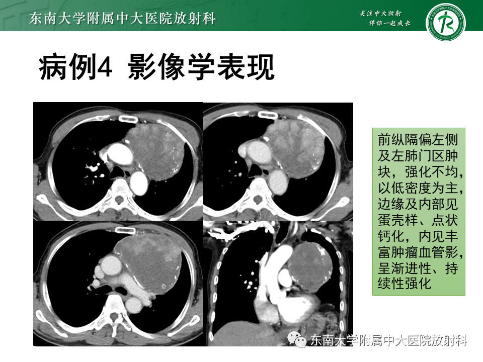 影像PPT - 【PPT】胸膜孤立性纤维瘤-27 影像PPT - 【PPT】胸膜孤立性纤维瘤-27