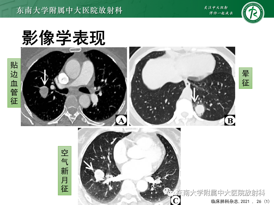 影像PPT - 【PPT】胸膜孤立性纤维瘤-30 影像PPT - 【PPT】胸膜孤立性纤维瘤-30