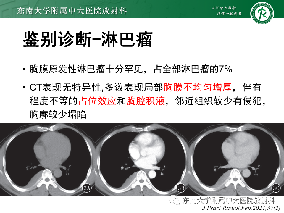 影像PPT - 【PPT】胸膜孤立性纤维瘤-37 影像PPT - 【PPT】胸膜孤立性纤维瘤-37