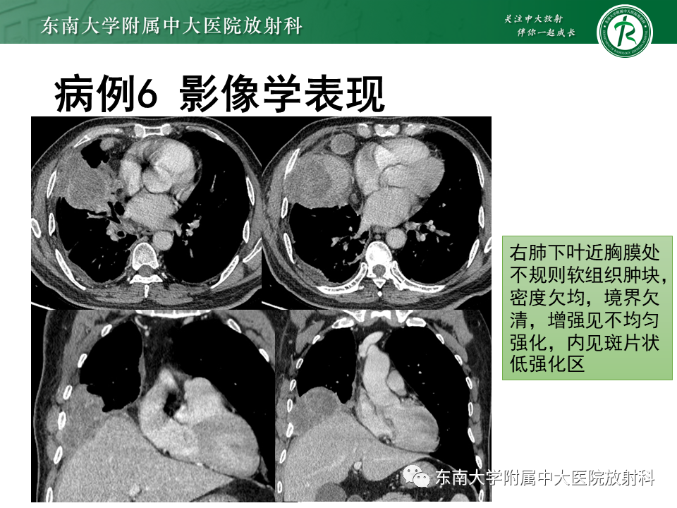 影像PPT - 【PPT】胸膜孤立性纤维瘤-36 影像PPT - 【PPT】胸膜孤立性纤维瘤-36