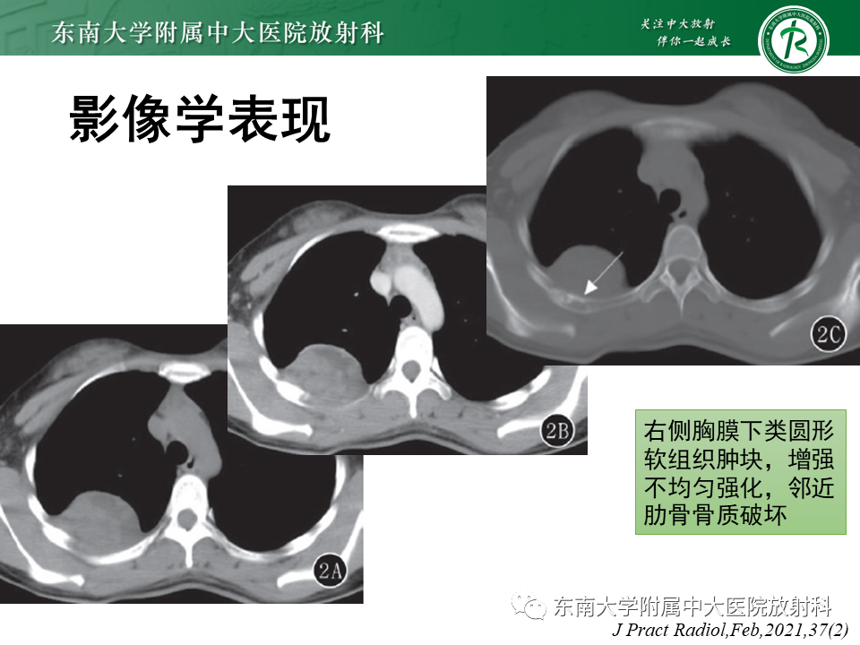 影像PPT - 【PPT】胸膜孤立性纤维瘤-39 影像PPT - 【PPT】胸膜孤立性纤维瘤-39